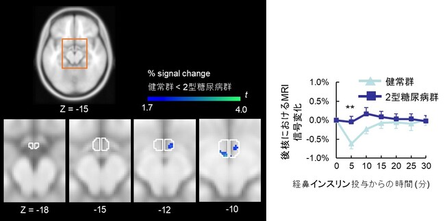 2型糖尿病における「脳のインスリン抵抗性」は視床下部後核に局在することを解明
