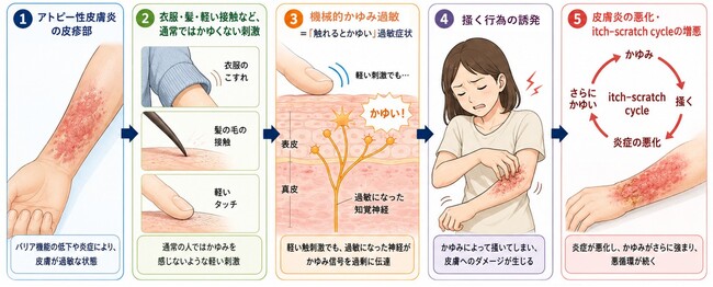 アトピー性皮膚炎患者の「触れるとかゆい」症状と相関する血液マーカーを発見