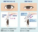 眼瞼下垂とは