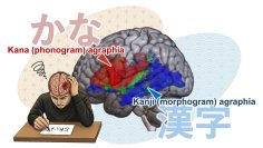 【横浜市立大学】仮名と漢字の書字障害には異なる脳内ネットワークの障害が関与